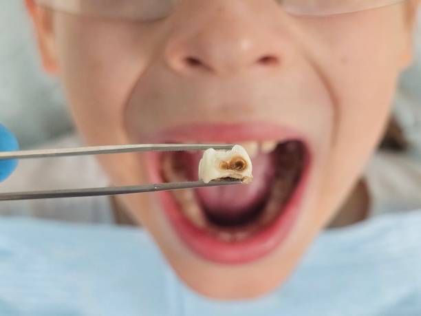Best Emergency Dental Services for Seniors in Russellville, AL